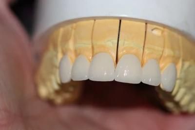 Dental Ultra Thin Porcelain Veneers From Midway Dental Lab