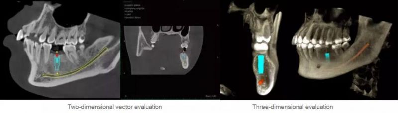 Hires 3D-Plus CE Professional Large Fov Dental 3D Cone Beam Computred Tomography Cbct Equipment