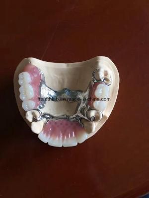 Cast Partial Framework Denture