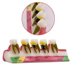 Denture Model Teaching Model Dental Clinic Doctor Patient Communication Dental Tooth Model