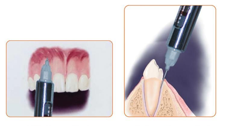 Professional Local Anesthesia Device for Oral Cavity