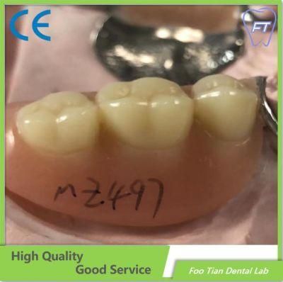 OEM Removable Denture Dental Implant Good Product