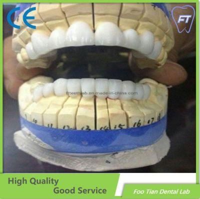 Customized Dental Metal Ceramic Crown Made in Foo Tian Dental Lab in Shenzhen China