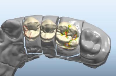 Dental 3shape/Exocad Smile Design Service From China Dental Lab