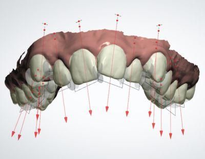 Clear Aligner/Teeth Straightening Alignersnvisible Braces Made by Midway Dental Lab