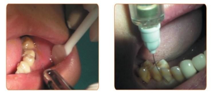 Pain Free Dental Injection Anesthesia Booster