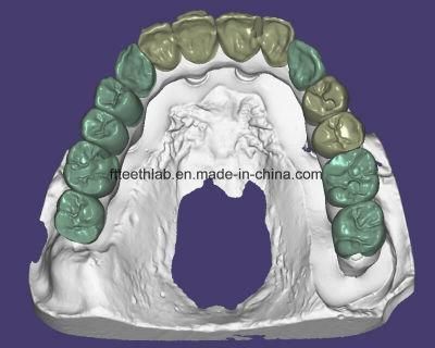 Dental Material Lab Implant Dental Lab Custom Full Arch Screwed Zirconia Implant Bridge