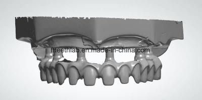 All on 4 Full Contour Zirconia Implant Upper Dental Implant Bridge