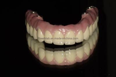 Full Arch Dental Implant Zirconia Bridge