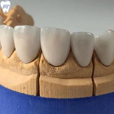 Dental Veneers in Cosmetic Dentistry Made in China Dental Lab