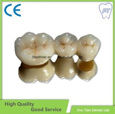 Fixed Restoration Dental Metal Ceramic Crown Made in Foo Tian Dental Lab in Shenzhen China