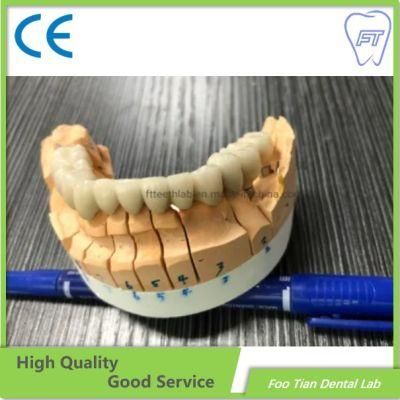 High Quality Dental Metal Ceramic Crown Made in Foo Tian Dental Lab in Shenzhen China