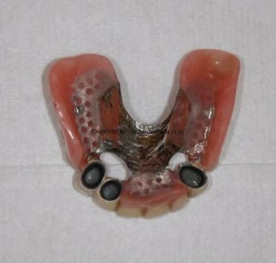 High Precision Telescopic Overdenture with Good Friction From China Dental Lab