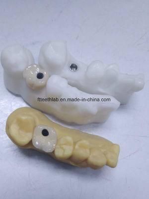 Dental Implant Metal Ceramic Crowns and Bridge From China