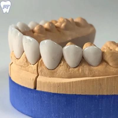 Cosmetic Dental Non-Prep Porcelain Veneers From China Dental Lab