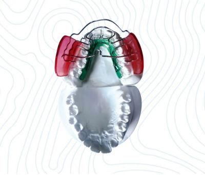 Dental Herbst Orthodontic Appliance From Midway Dental Lab