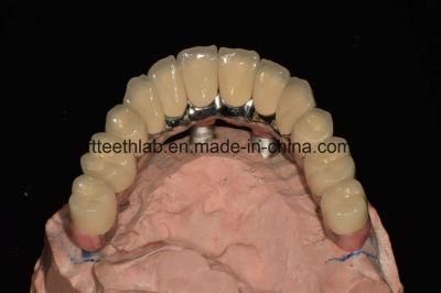 All-on-Four Implant Bridge From China Dental Lab