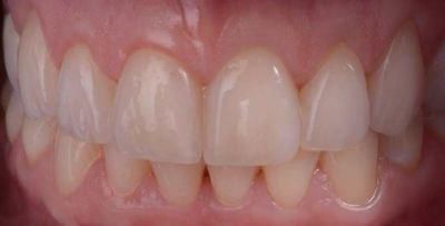 Non Prep Ultra Thin Veneers From China Dental Lab