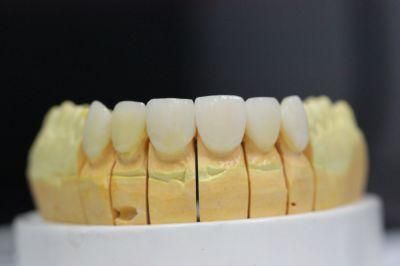 Dental Porcelain Veneers From China Midway Dental Lab