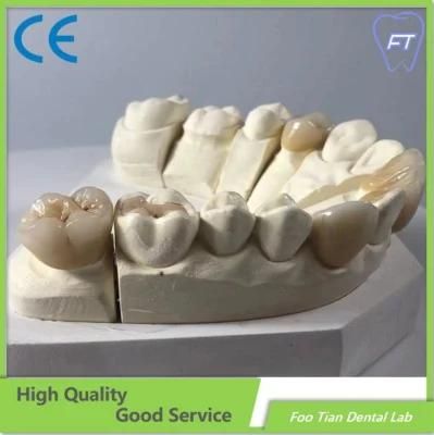 High Quality Dental Implant Emax Dental Inlays and Crowns with High Aesthetic