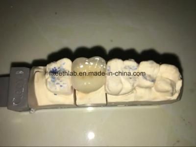 Dental Pfm Crown Made From China Dental Lab