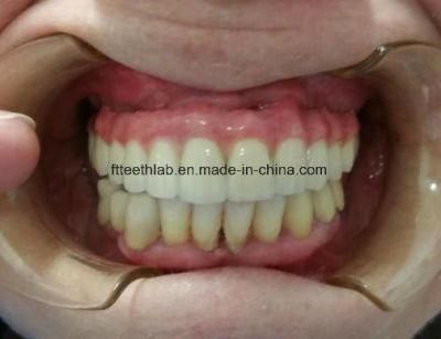 Dental Material Lab Implant Dental Lab Custom Full Arch Cemented Metal Ceramic Implant Bridge