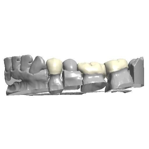 Dental Crown Bridge Veneer Metal Framework Implant Bar Design Service