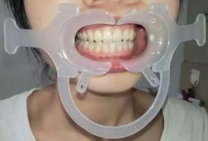Cheek Retractors Teeth Whitening Dental Mouth Opener/C Type Disposable