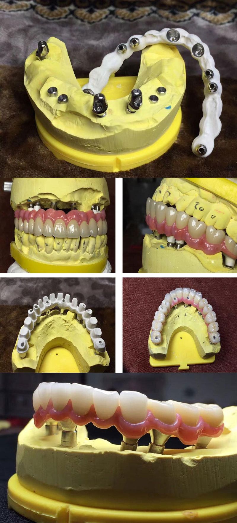 Dental Material Implant Supplies All-on-6 Full Contour Zirconia Upper Dental Implant Bridge