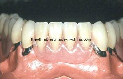 Dental Material Lab Implant Dental Lab Custom Telescopic Denture