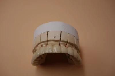 Dental Metal Porcelain Crown From Midway Dental Lab