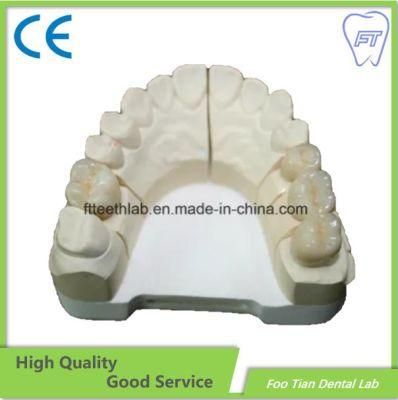 Oral Health Dental Metal Ceramic Crown Made in Foo Tian Dental Lab in Shenzhen China