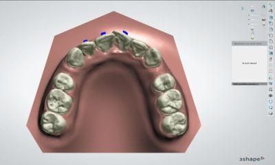 Invisible Braces Price/Invisible Teeth Aligners/Clear Orthodontics/Retainer After Invisible Aligner