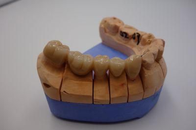 Dental Porcelain Fused to Metal Crown From China Dental Lab