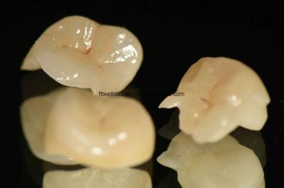 Dental All Ceramic Inlays Onlays Made in China Dental Lab