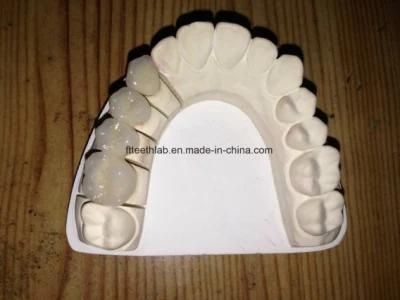 Dental Metal Ceramic Crowns and Bridge From China Dental Lab