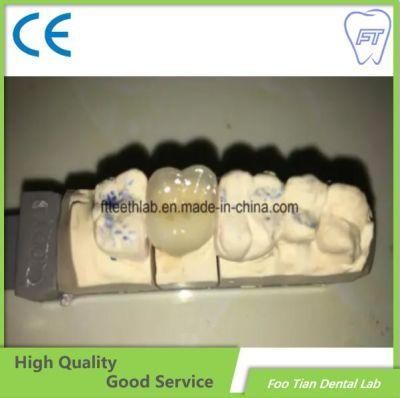 Dental Treatment Dental Metal Ceramic Crown Made in Foo Tian Dental Lab in Shenzhen China