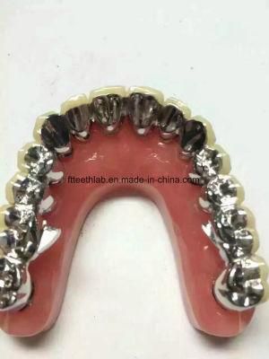 Dental Porcelain Fused to Metal Bridge with Full Metal Occlusal