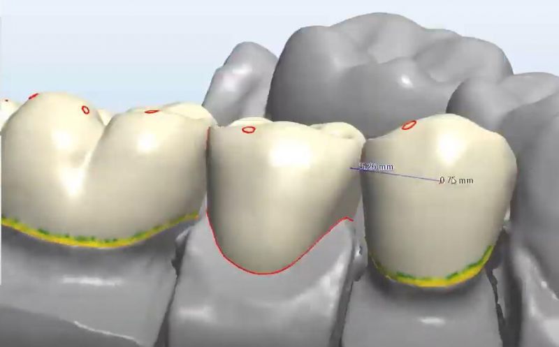 Dental Crown Bridge Veneer Metal Framework Implant Bar Design Service