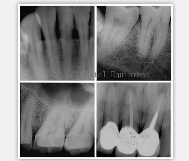 Dental Imaging System High Frequency Portable Dental X-ray Machine