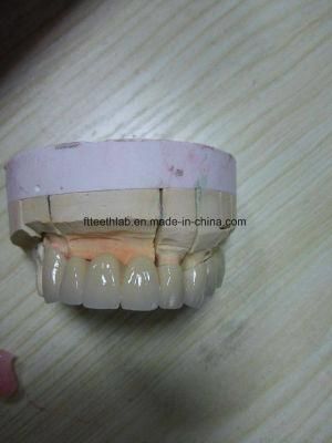 Dental Porcelain Fused to Metal Bridge Made From China Dental Lab in Shenzhen China