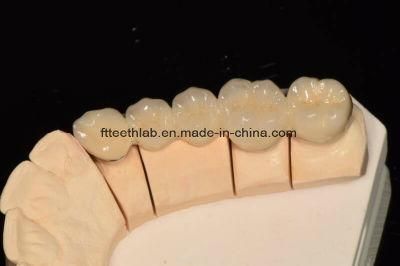 Pfm Crowns and Bridge with Transparent Incisal