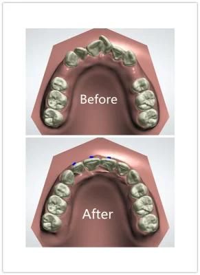 Dental Invisible Aligner/Braces on Crooked Teeth/Smile Teeth Straightening