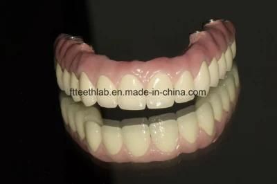 Dental Full Arch Malo Implant Bridge