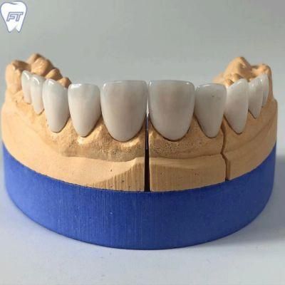Dental Material Lab Implant Dental Lab Custom Non-Prep IPS E. Max Veneers with High Aesthetic