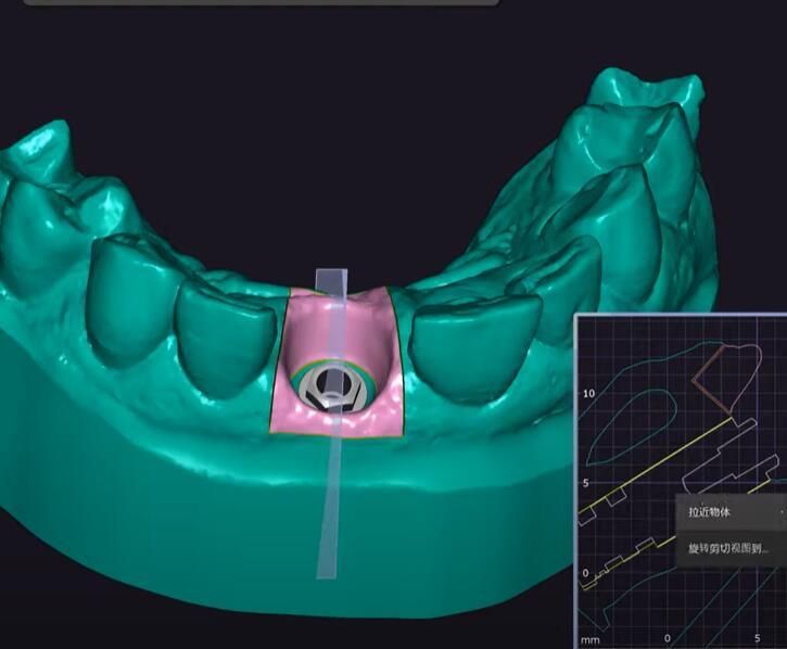 Dental Custom Abutment Full Partial Denture Smile Design Service