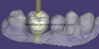 Dental Implant Crown Made on 3D Printed Models