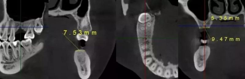 Hires 3D Dental Cbct Implant Inspection Equipment Implant Simulation Tmj Image New Cephalometric Seat Cbct