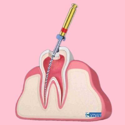 Endo Files for Root Canal Treatment