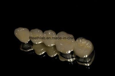 Porcelain Fused to Metal Bridge Made in China Dental Lab